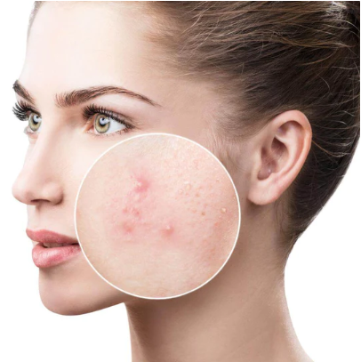 Home Chemical Ls Anti Aging Acne