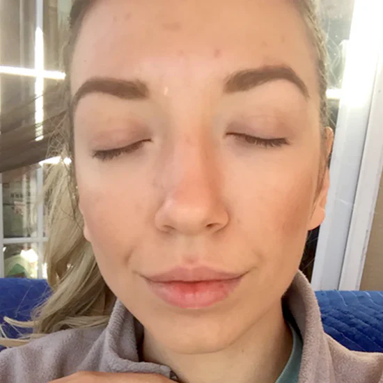 Skin after using Makeup Artist’s Choice skincare treatment