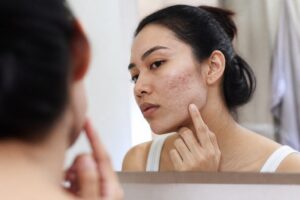 How to Fade Acne Hyperpigmentation at Home