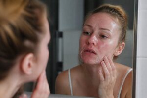 Chemical Peel Downsides: What to Know