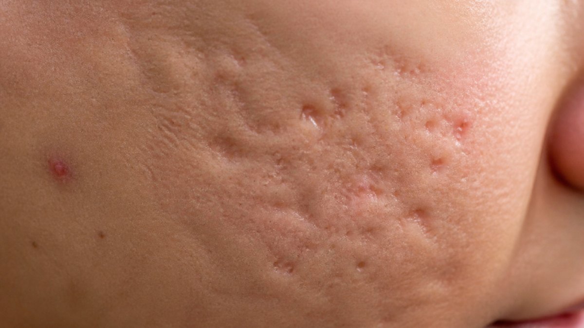 Close-up of skin showing various acne scar textures and depressions with natural side lighting, demonstrating wave-like rolling patterns and sharply defined boxcar indentations for comparison