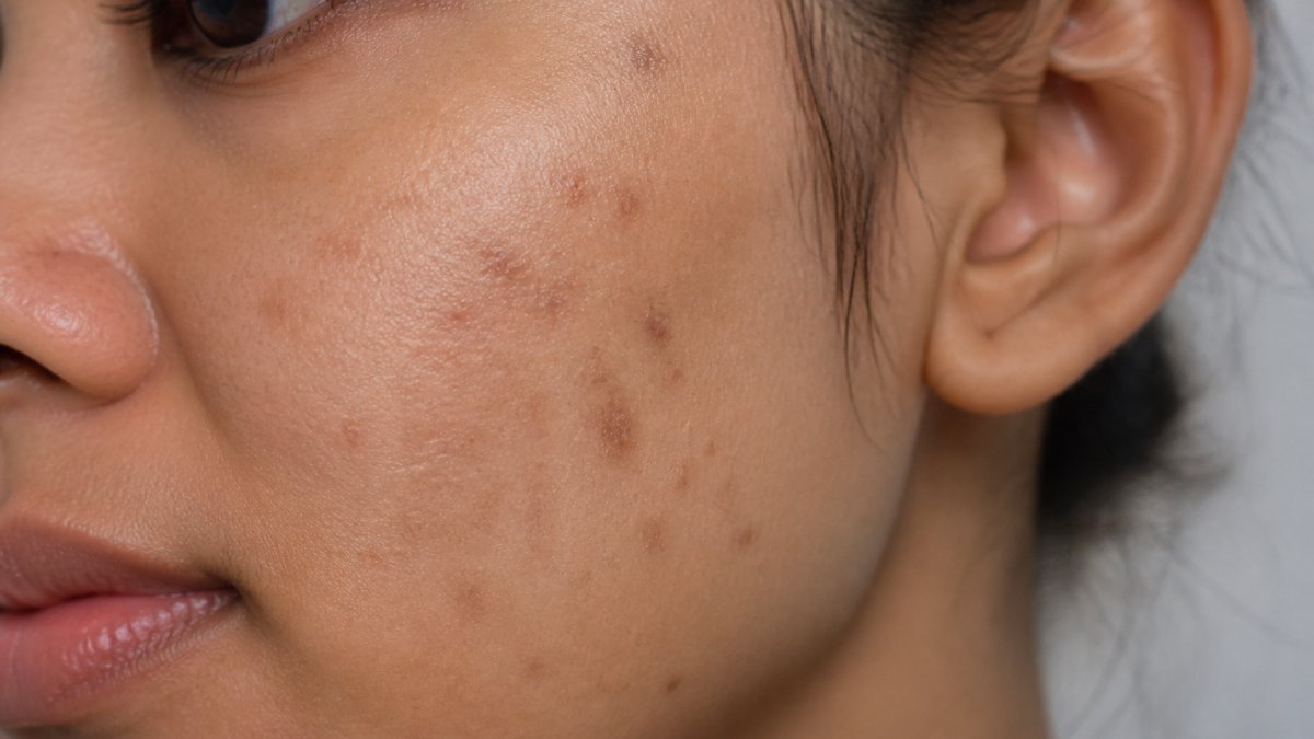 Close-up of skin showing areas of post-inflammatory hyperpigmentation and uneven skin tone on a person's face after acne healing